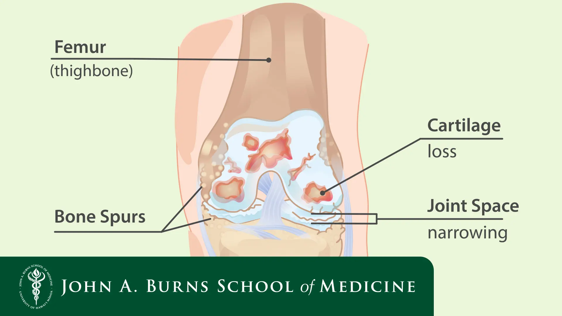 knee osteoarthritis